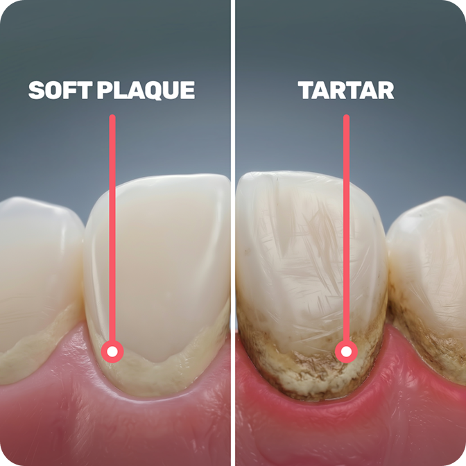Tartar always starts as soft plaque