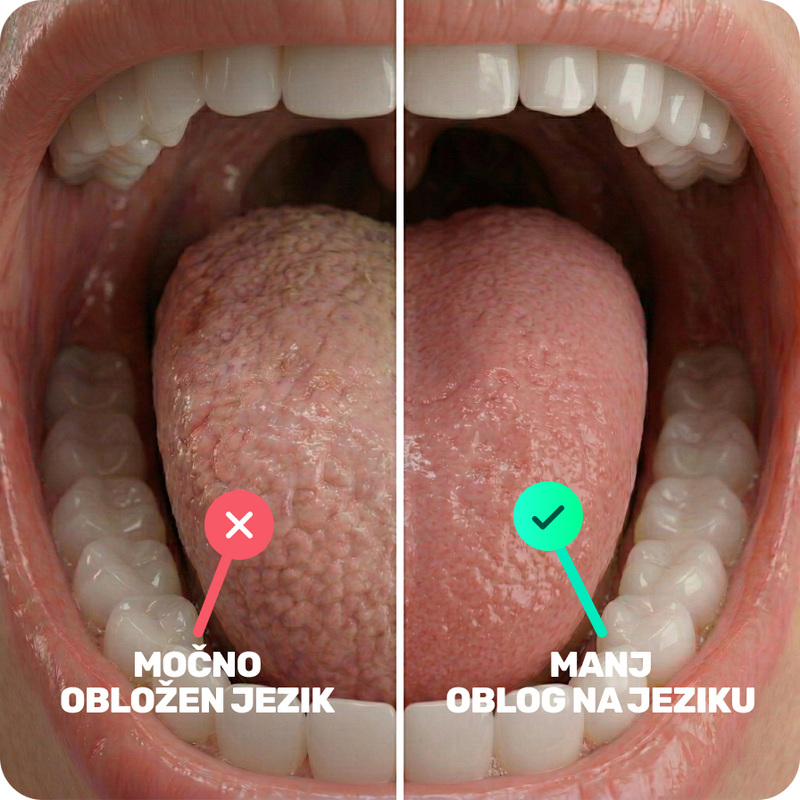 Strgalo za jezik za zmanjšanje količine bakterij v ustih