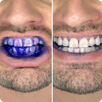 The ultimate plaque Eliminator