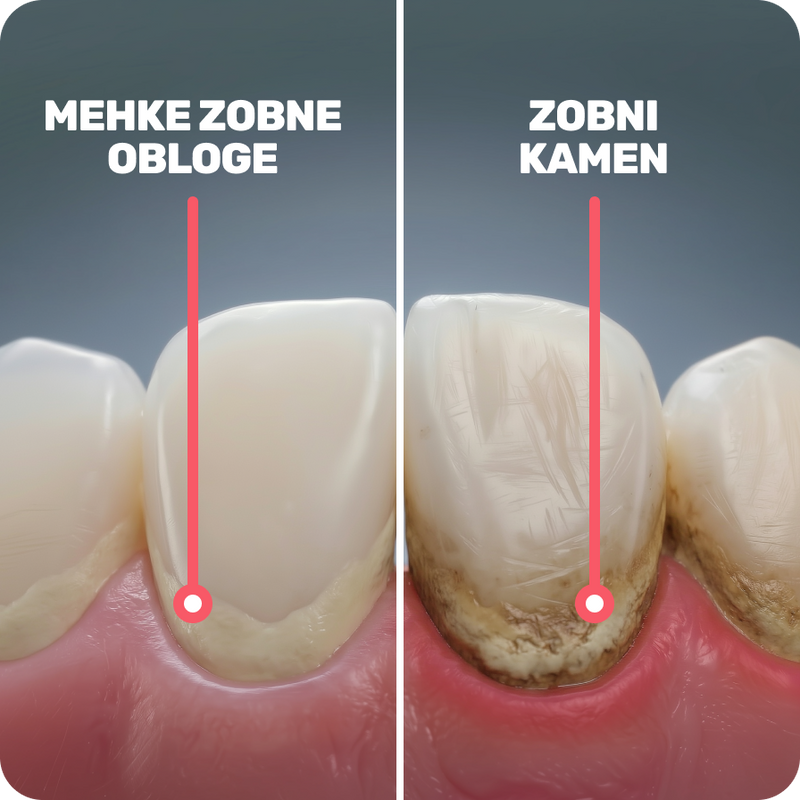 Zobni kamen vedno nastane iz mehkih oblog